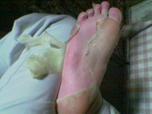 dead skin peeling off the bottom of my feet