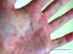 Rocky Mountain Spotted Fever - Petechial Rash